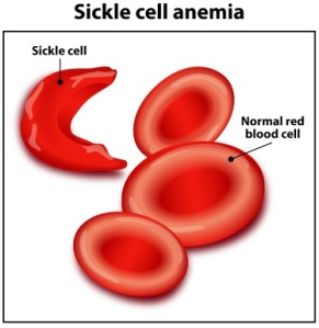Sickle cell anemia-1 copy_detail