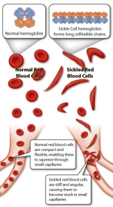 sicklecell